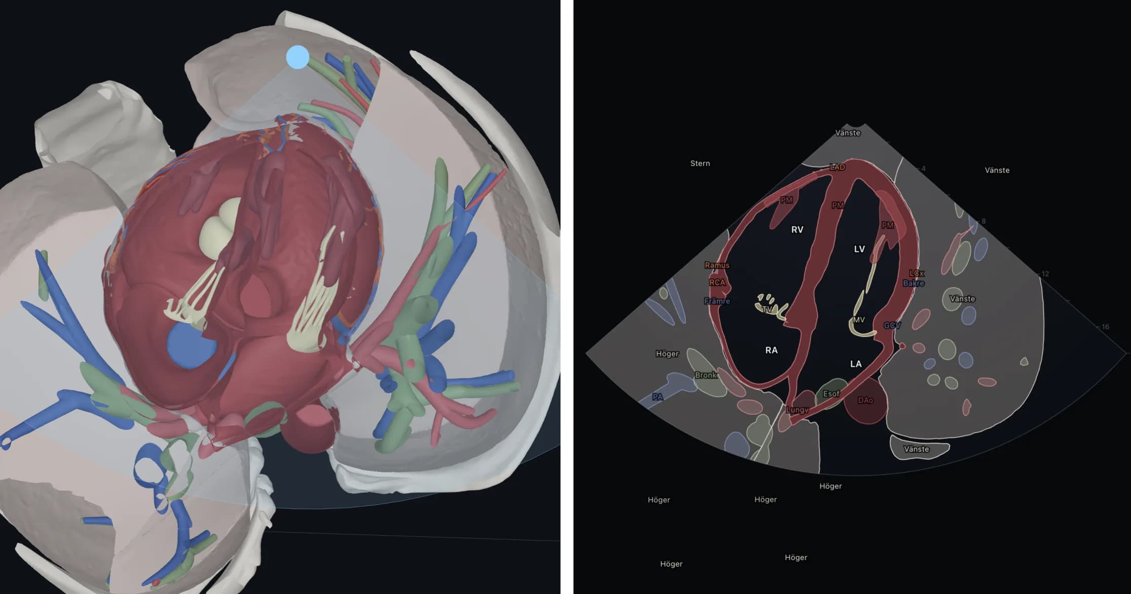Le cœur en 3D coupé en vue apicale des quatre cavités, à côté de la même coupe tracée comme une image échographique