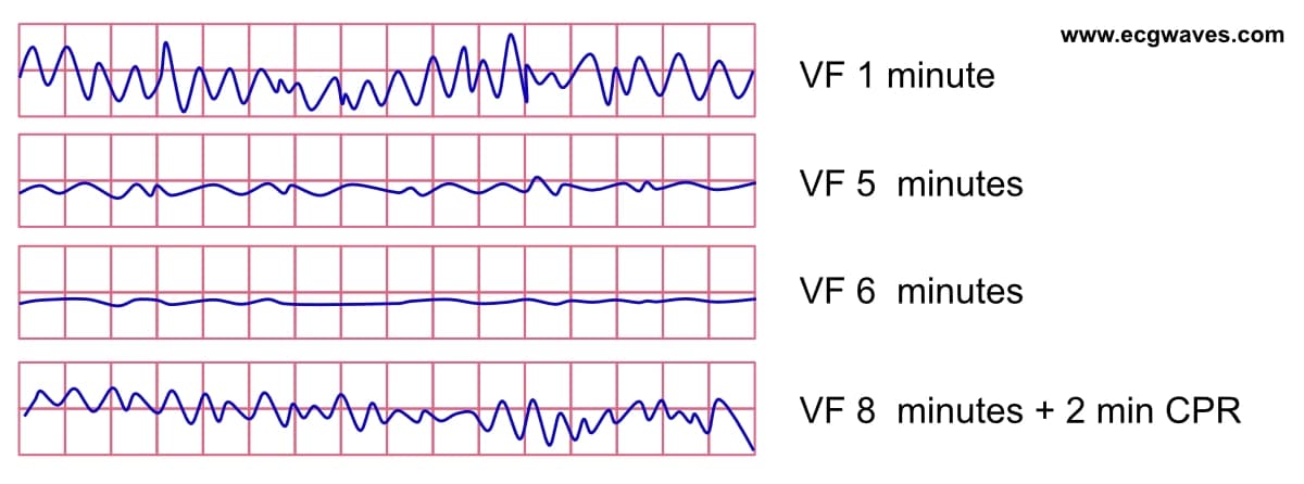 Illustration ur kursen Arrêt cardiaque soudain et réanimation cardio-pulmonaire (RCP)