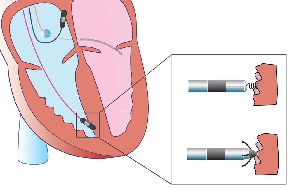 Illustration ur kursen Stimulateurs cardiaques et dispositifs cardiaques
