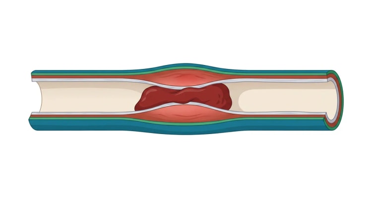 Coupe longitudinale d'une veine dont la lumière est ouverte. La paroi vasculaire est épaissie et rouge dans sa partie centrale, et un thrombus rouge sombre y adhère par une large base, tandis que le vaisseau reste perméable de part et d'autre du thrombus.