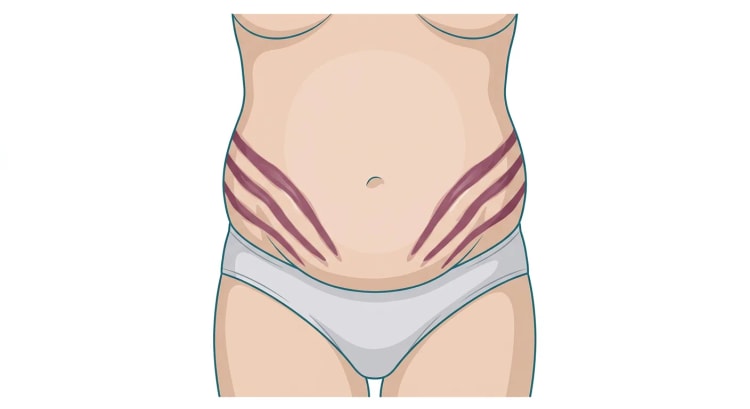 Dessin de la partie inférieure du tronc vue de face chez une personne présentant une obésité abdominale. Sur les deux flancs et sur la partie basse de l'abdomen, plusieurs vergetures larges et pourpres forment des bandes parallèles obliques descendantes.