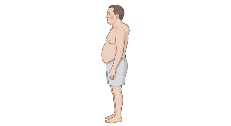 Dessin d'un homme de profil au visage arrondi et bouffi avec une joue rouge, un cou court et large, une obésité abdominale centrale importante et des bras et des jambes remarquablement grêles.