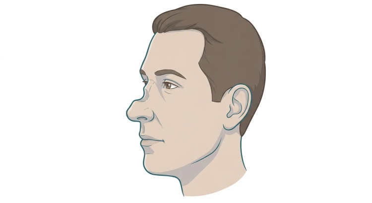 Tête de profil d'un adulte d'âge moyen dont la partie médiane de l'arête nasale est affaissée, de sorte que la ligne du profil forme un creux net entre la racine du nez et la pointe nasale arrondie, légèrement retroussée.