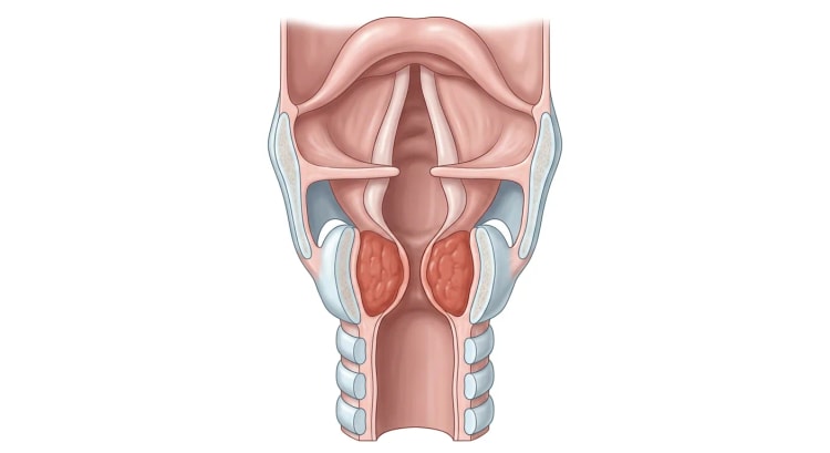 Coupe frontale du larynx et de la trachée haute où une muqueuse rouge et épaissie, juste sous les cordes vocales, bombe des deux côtés et rétrécit la lumière en sablier, tandis que la trachée sous-jacente a un calibre normal.