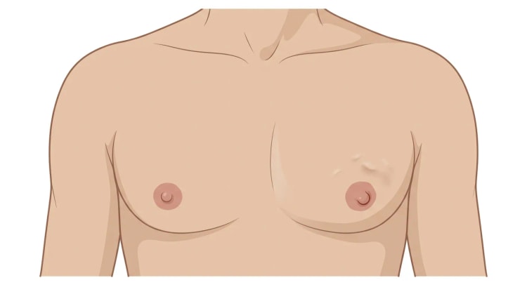 Vue de face du thorax d'un homme. Le côté droit est normal ; du côté gauche, on observe une rétraction cutanée irrégulière au-dessus et en dehors de l'aréole ainsi qu'un mamelon rétracté.