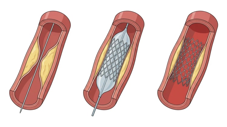 Trois segments coronaires ouverts montrant une sténose avec un guide, un ballon gonflé portant un stent et un stent déployé laissé en place.