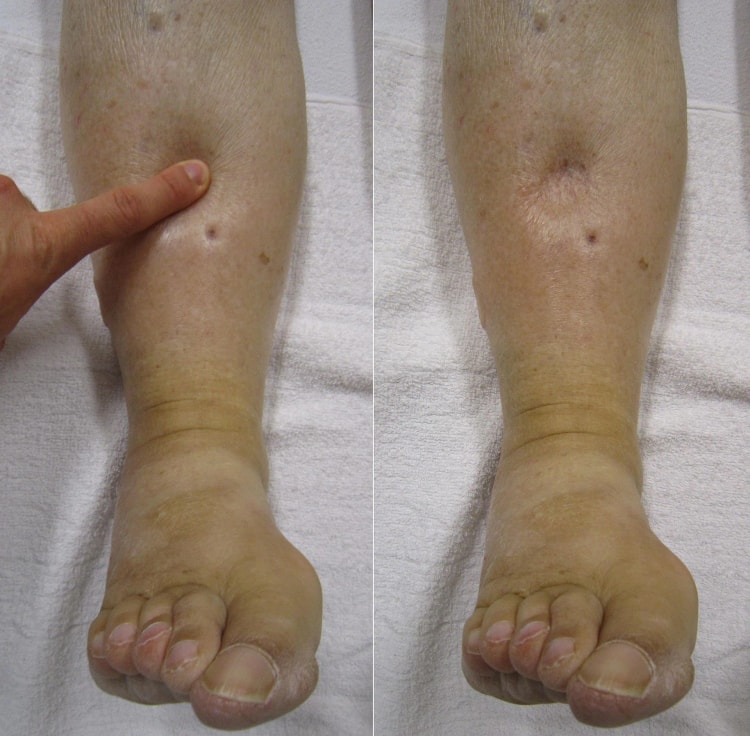 Œdème prenant le godet de la jambe.