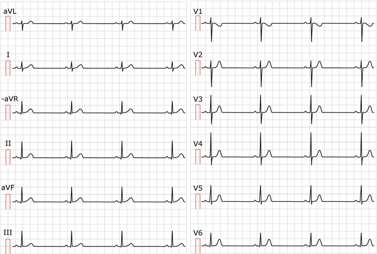 Figure 1. Sinus bradycardia. Paper speed 25 mm/s. Calculate the rate by dividing 300 by the number of large boxes between two cycles (e.g between two R waves). As seen in the figure, there are approximately 6.5 large boxes between two R waves. 300/6.5 equals 46 beats/min.