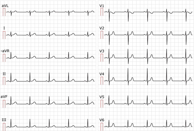 Figure 1. Sinus rhythm. Paper speed 25 mm/s.