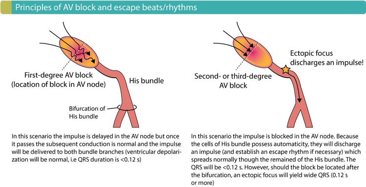 Figure 2. Principles of AV blocks and the emergence of escape rhythms / beats.