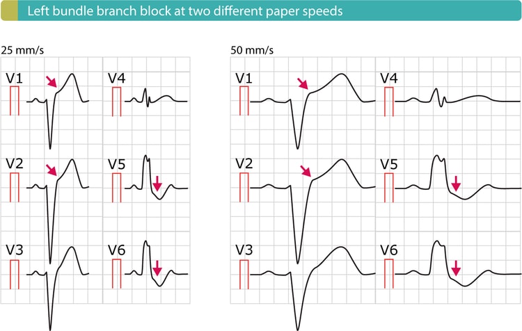 Figure 7. Left bundle branch block (LBBB) also causes secondary ST-T changes, including ST segment elevation.