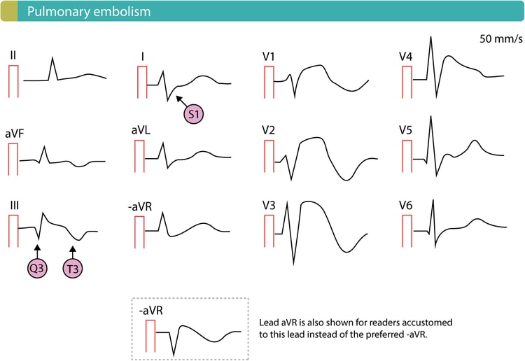 Figure 13. Pulmonary embolism with ST-segment elevations in right sided chest leads.