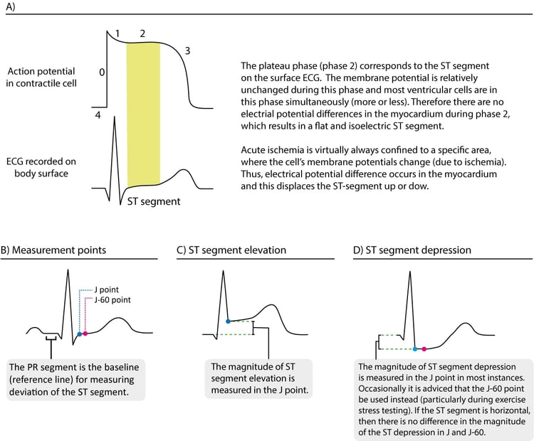 Figure 1. (A) La relation entre le potentiel d’action et la courbe ECG. L’ischémie myocardique affecte principalement la repolarisation, ce qui se traduit par des modifications ST-T sur l’ECG. (B) Notez que le niveau de référence pour mesurer la déviation (élévation ou dépression) du segment ST est le segment PR (la partie terminale de l’intervalle PR). (C) et (D) montrent comment mesurer l’ampleur de l’élévation et de la dépression du segment ST. Le point J 60 est situé 60 ms après le point J.