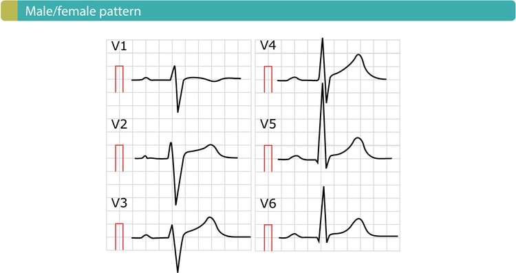 Figure 4. Male/female pattern. Also called 