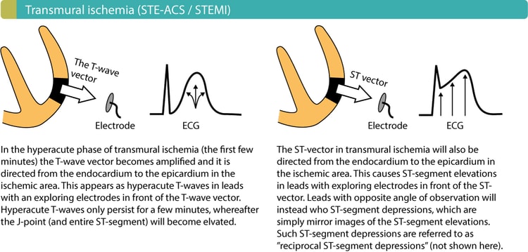 Figure 3. Courants de lésion dans l’ischémie myocardique transmurale. Notez que l’infarctus du myocarde avec sus-décalage du segment ST (STEMI/STE-ACS) provoque généralement aussi des sous-décalages du segment ST dans les dérivations opposées à celles qui présentent les sus-décalages du segment ST. Cependant, la principale modification de l’ECG dans le STEMI/STE-ACS est le sus-décalage du segment ST.