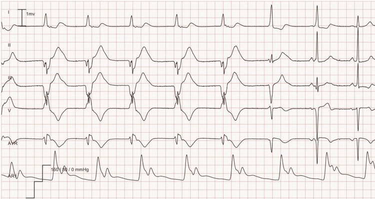 ECG Example: Idioventricular rhythm (accelerated ventricular rhythm) – Accelerated ventricular rhythm at a rate of 56 for the first 5 beats followed by 2 fusion beats; the last 2 beats are normal sinus rhythm.