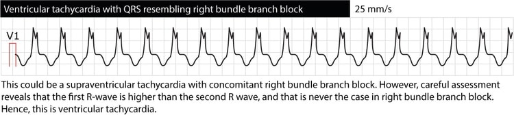 Figure 4. Ventricular tachycardia with right bundle branch block (RBBB) morphology. However, the first R-wave is larger than the second R-wave, which is not the case in RBBB. This suggests that the rhythm is not a supraventricular tachycardia conducted with RBBB, but rather ventricular tachycardia (VT).
