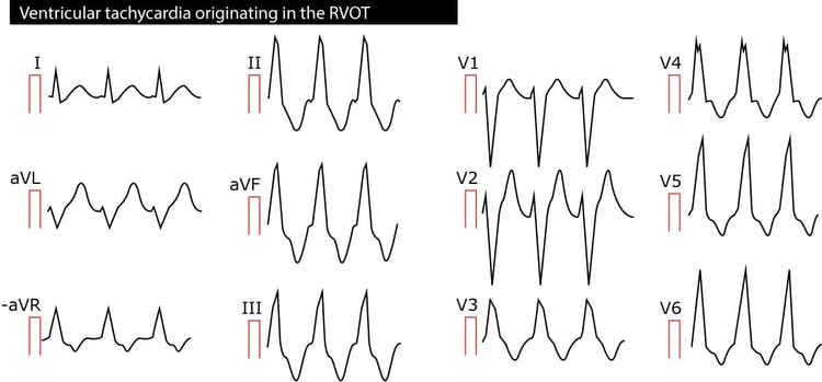 Figure 2. Ventricular tachycardia (VT) originating in the right ventricular outflow tract (RVOT).