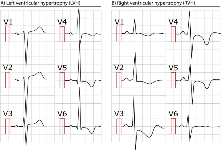 Figure 2. Two ECGs showing left and right ventricular hypertrophy.