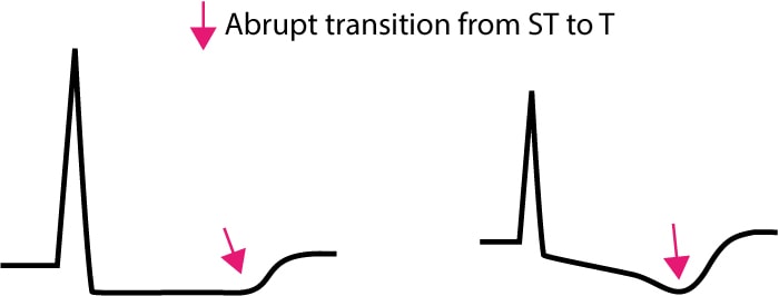 Figure 2. Transition from ST segment to T-wave in ischemia.