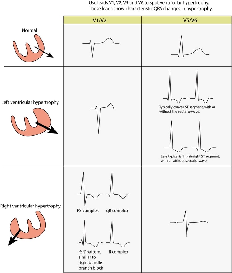 Figure 1. Modifications de l’ECG observées dans l’hypertrophie ventriculaire gauche (HVG) et l’hypertrophie ventriculaire droite (HVD). Le vecteur électrique du ventricule gauche est renforcé dans l’hypertrophie ventriculaire gauche, ce qui se traduit par de grandes ondes R dans les dérivations du côté gauche (V5, V6, aVL et I) et des ondes S profondes dans les dérivations thoraciques du côté droit (V1, V2). L’hypertrophie ventriculaire droite provoque de grandes ondes R dans les dérivations thoraciques droites et des ondes S plus profondes dans les dérivations gauches.