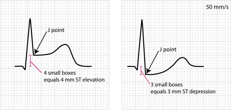 Figure 14. Example of measuring ST deviation (elevation and depression).