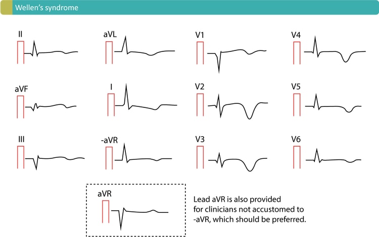 Figure 3. Characteristic T-wave inversions caused by Wellen