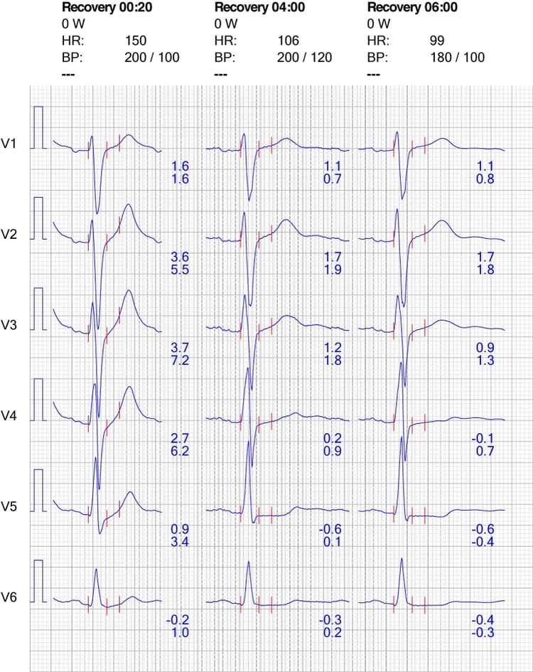 Figure 10. ECG reaction in chest leads during recovery.