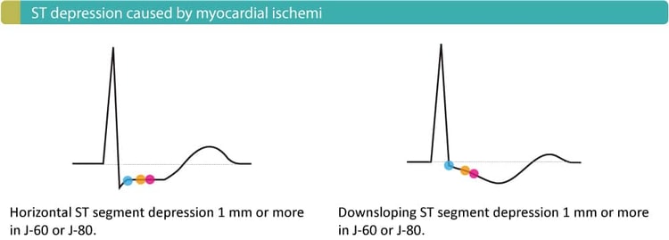 Figure 3. ST segment depressions that are typical of ongoing myocardial ischemia.