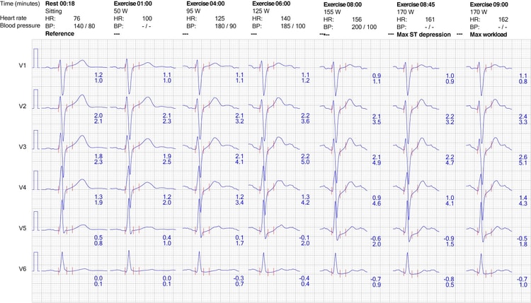 Figure 9. ECG reaction in chest leads during exercise.