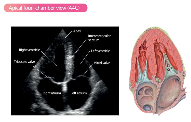 Figure 12. Apical four-chamber view (A4C).