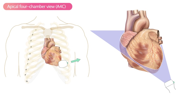 Figure 11. Apical four-chamber view (A4C).