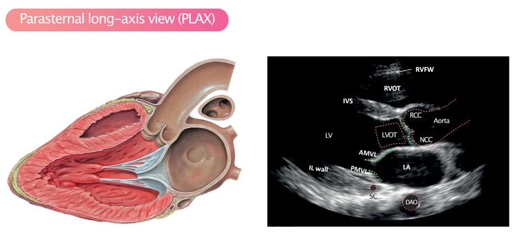 Figure 3. PLAX. RVFW = Right ventricular free wall; RVOT = Right ventricular outflow tract; RCC = right coronary cusp; NCC = Non coronary cusp; LA = left atrium; LV = Left ventricle; IL wall = inferolateral wall; IVS = Interventricular septum (anterior aspect); AMVL = Anterior mitral valve leaflet; PMVL = Posterior mitral valve leaflet; DAO = Descending aorta.