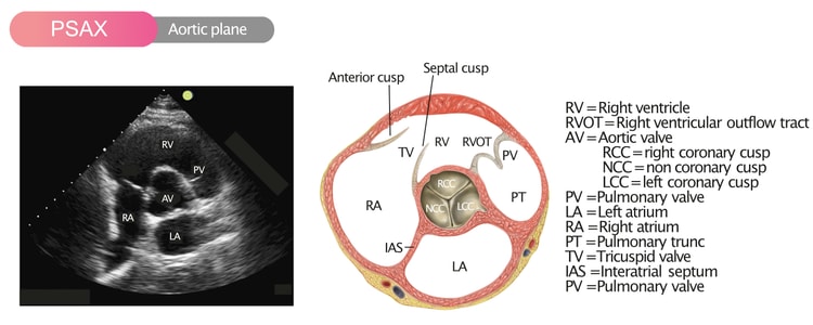 Figure 7. Parasternal short axis view (PSAX) in the aortic plane.