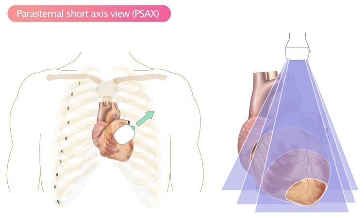 Figure 6. Parasternal short-axis view (PSAX).