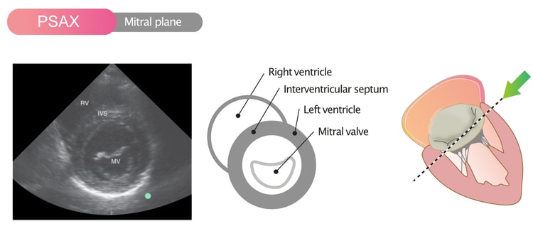 Figure 8. Parasternal short axis view (PSAX) in the mitral valve plane.