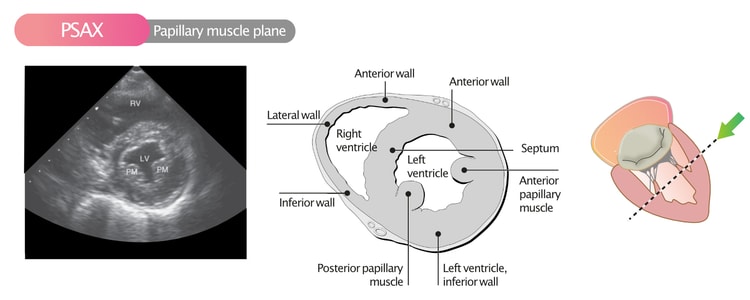 Figure 9. Parasternal short axis view (PSAX) in the papillary muscle plane.