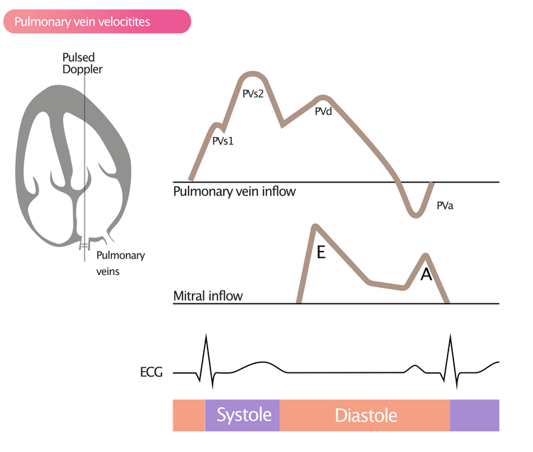 Figure 5. Measurement of pulmonary vein velocities with pulsed Doppler. 