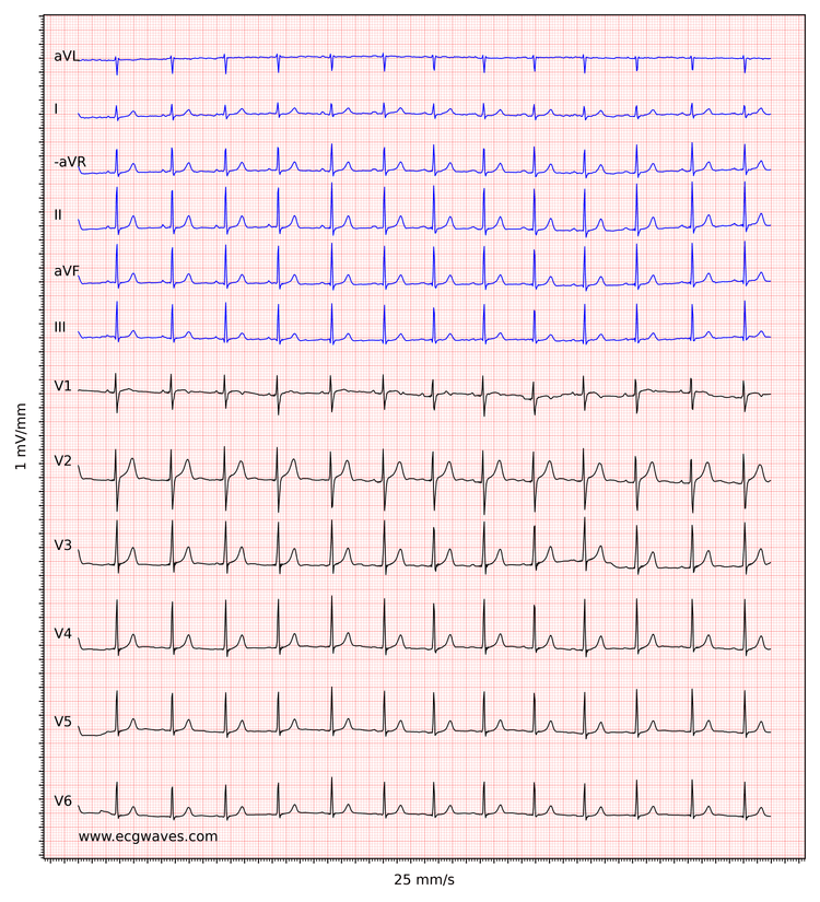 ECG example 1. Normal sinus rhythm.