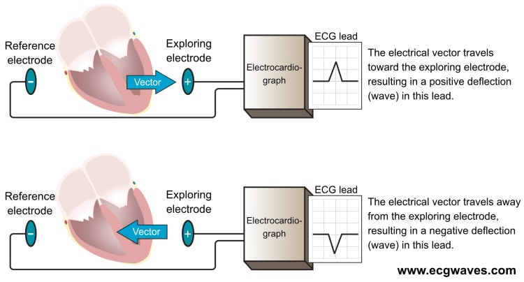 Figure 6. An ECG lead displays an ECG curve (diagram). At least two electrodes are necessary to obtain an ECG lead. One of the electrodes serves as reference and the other serves as exploring electrode. The electrocardiograph compares the electrical potentials detected in the electrodes. If a vectors travels towards the exploring electrode, and away from the reference electrode, a positive wave is printed.