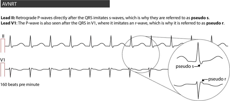 Figure 3. AVNRT in a 20-year old male suffering from palpitations.