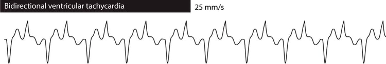 Figure 2. Bidirectional ventricular tachycardia
