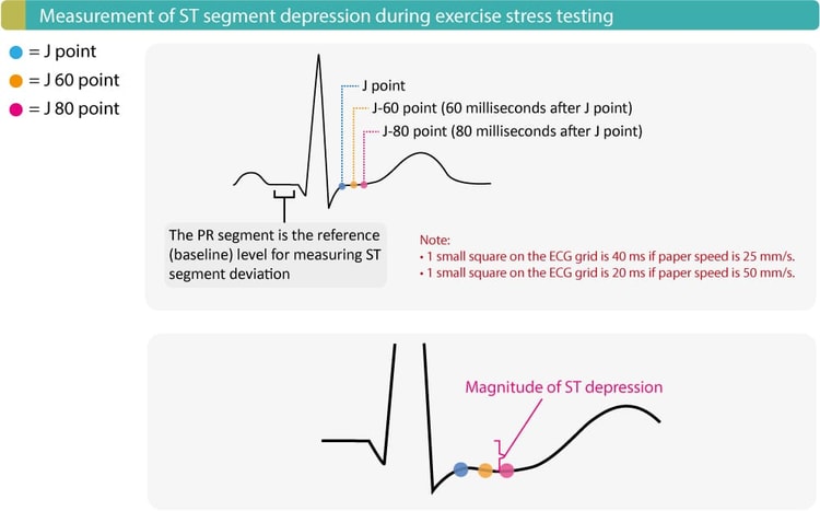 Figure 2. Measurement of ST segment depression during exercise stress testing.