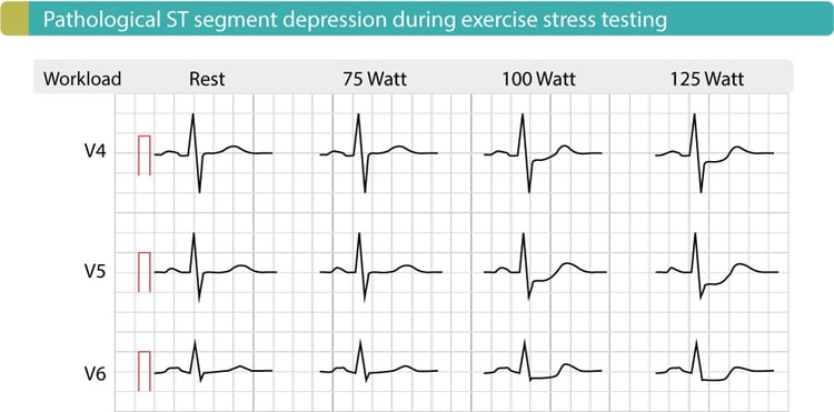 Figure 5. Exercise ECG in patient with coronary artery disease shows significant ST depressions in J-60 point, J-80 point. These depressions become more pronounced as workload increases. This test was performed on bicycle.