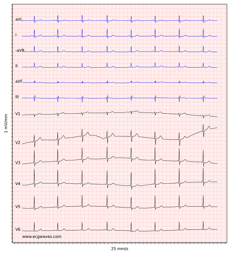 Figure 4. Sinus bradycardia.