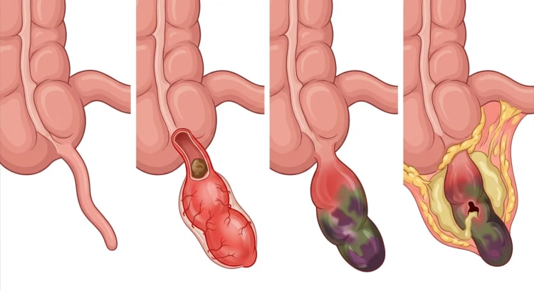 Quatre images du cæcum avec l'appendice : normal, inflammatoire avec un stercolithe, gangréneux, et perforé avec un abcès entouré par l'épiploon.