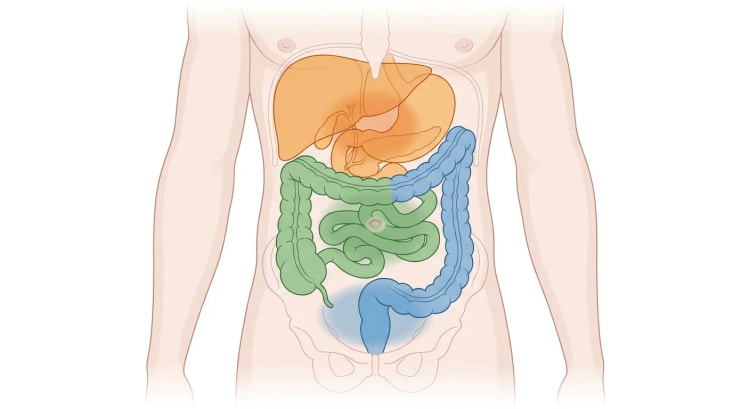 Organes abdominaux vus de face, codés par couleur selon leur origine embryologique, avec les zones douloureuses correspondantes dans l'épigastre, la région périombilicale et l'hypogastre.
