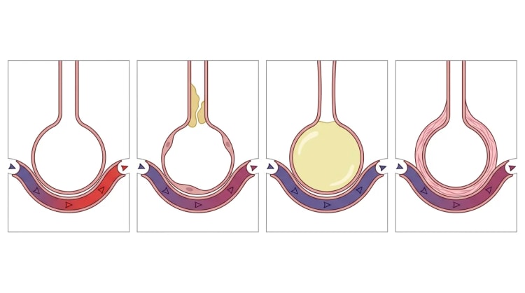 Quatre alvéoles schématiques avec leurs capillaires : normale, voie aérienne obstruée par du mucus, alvéole remplie de liquide et paroi alvéolaire épaissie, avec une couleur du sang passant du bleu au rouge ou restant inchangée.