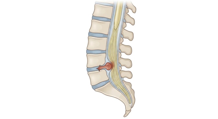 Coupe sagittale du rachis lombaire et du sacrum où la moelle spinale se termine au cône médullaire et un faisceau de racines nerveuses se poursuit vers le bas dans le sac dural. Une hernie discale centrale entre la quatrième et la cinquième vertèbre lombaire fait saillie dans le canal rachidien et comprime les racines nerveuses.