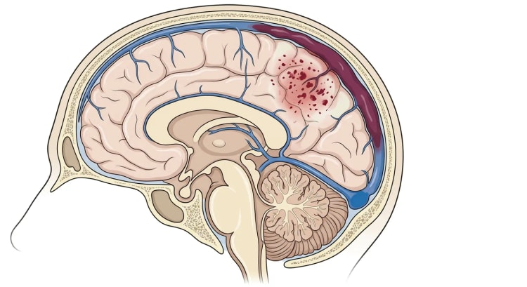 Coupe médiane de la tête avec une thrombose de la partie postérieure du sinus sagittal supérieur et un infarctus veineux hémorragique parasagittal adjacent.